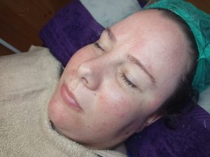 dermaplaning cheltenham - amy adelaide beauty1